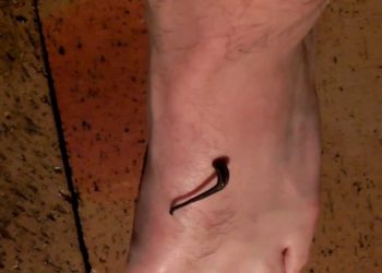 how do you remove a leech