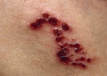 How long do T Lock shingles last?